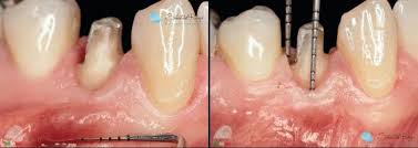 Crown Lengthening Procedure
